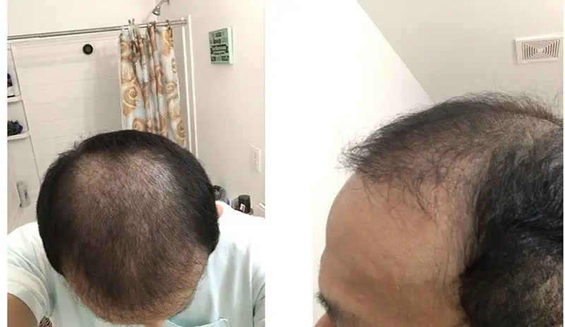 Nang tóc mới phát triển dày và đều màu