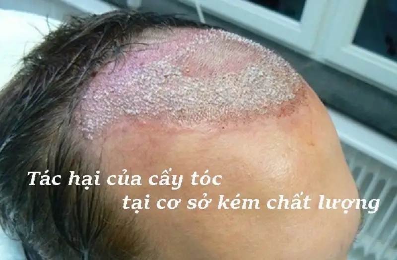 Cấy tóc tại cơ sở kém chất lượng gây nhiễm trùng, tổn thương các nang tóc