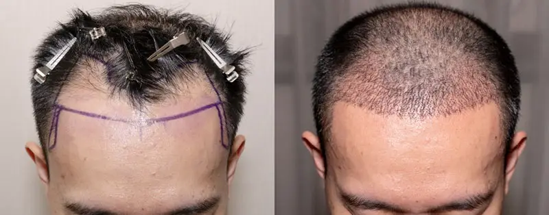 Nang tóc cần thời gian phục hồi và thích nghi sau cấy tóc