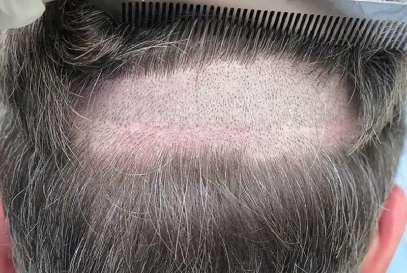 Cấy tóc không cần phải cạo hết đầu, chỉ cần cạo 1 phần