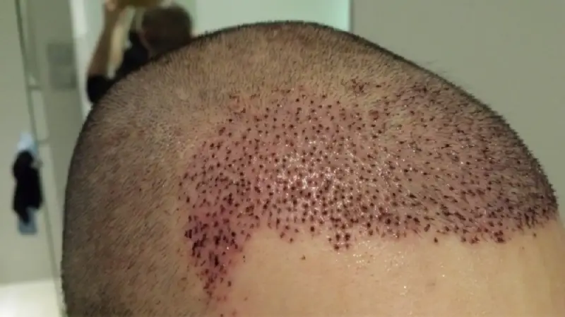 Nhiễm trùng sau cấy tóc xảy ra khi quy trình thực hiện không đảm bảo an toàn