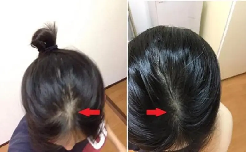 Nang tóc mọc ổn định, giúp các mẹ sau sinh khắc phục tình trạng hói đỉnh đầu