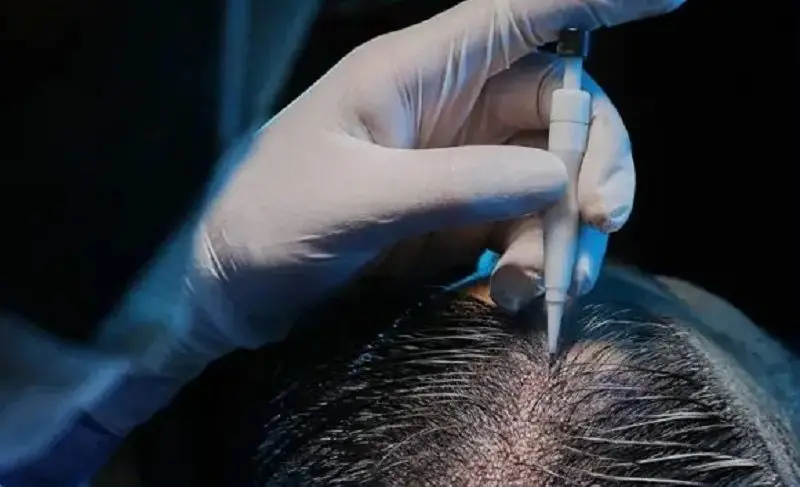 Bác sĩ thao tác cấy tóc chuẩn y khoa