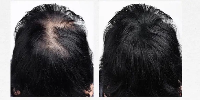 Cấy tóc đỉnh đầu giúp khắc phục tình trạng rụng tóc, hói đầu