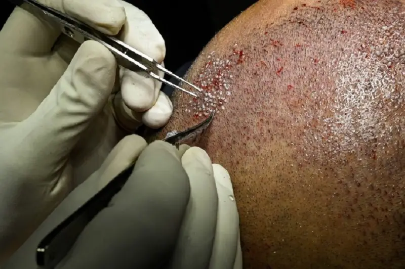 Thời gian cấy tóc phụ thuộc vào lượng tóc cần cấy