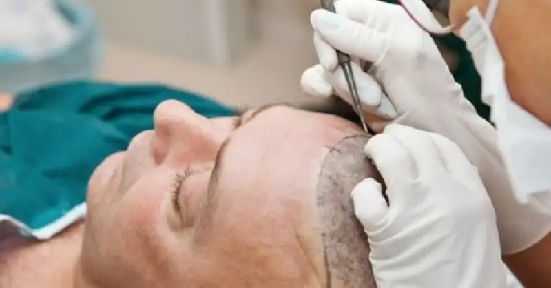 Kỹ thuật cấy tóc ảnh hưởng đến thời gian thực hiện