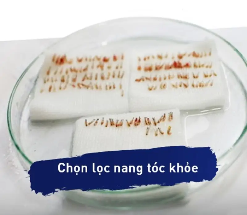 Lựa chọn nang tóc khỏe mạnh để cấy nếu khách hàng cấy tóc tự thân