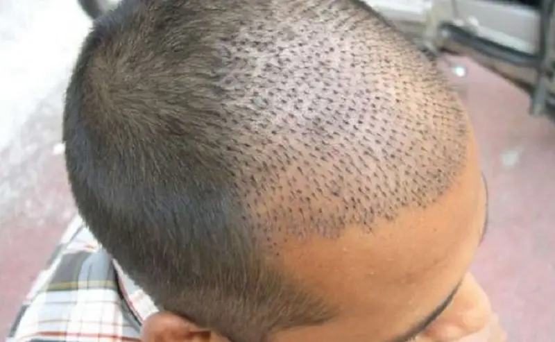 Cấy tóc sau 1 tháng những nang tóc mới đã bắt đầu thích nghi với vùng da đầu