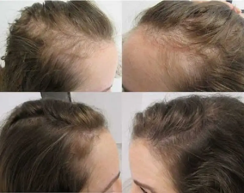 Cấy tóc sinh học có thể giữ được trong vài năm