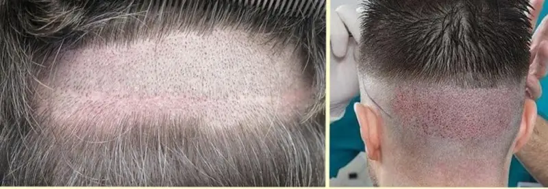 Nên lựa chọn địa chỉ cấy tóc uy tín, để giúp duy trì kết quả lâu dài