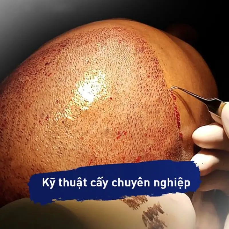 Ứng dụng kỹ thuật cấy tóc chuyên nghiệp