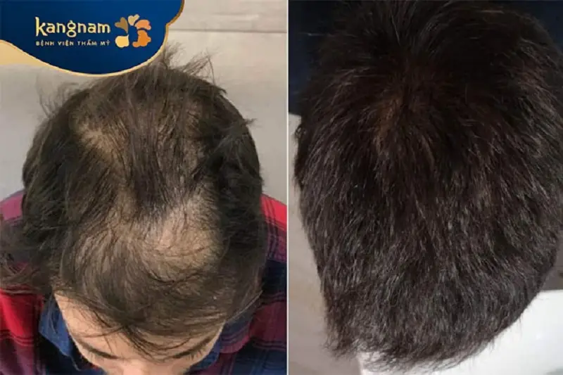Tóc mọc dày, khỏe và tự nhiên sau cấy tóc