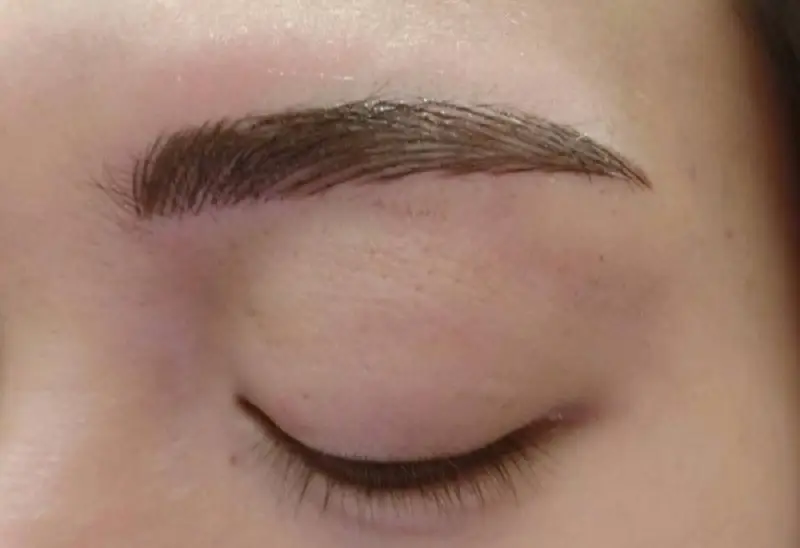 Kỹ thuật đi kim sâu có thể để lại sẹo