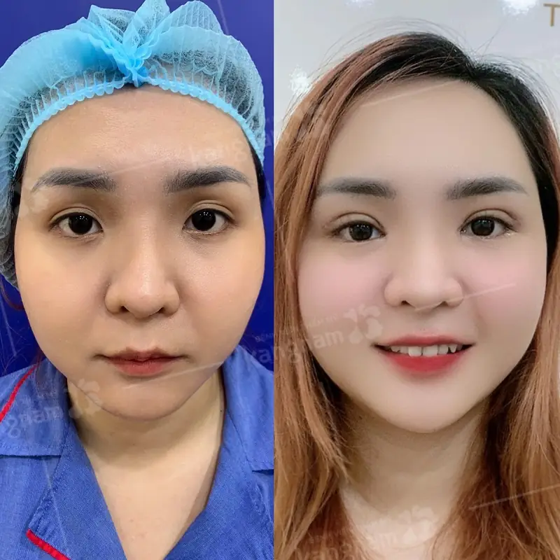 Cắt mí khắc phục được mọi khuyết điểm ở mí mắt