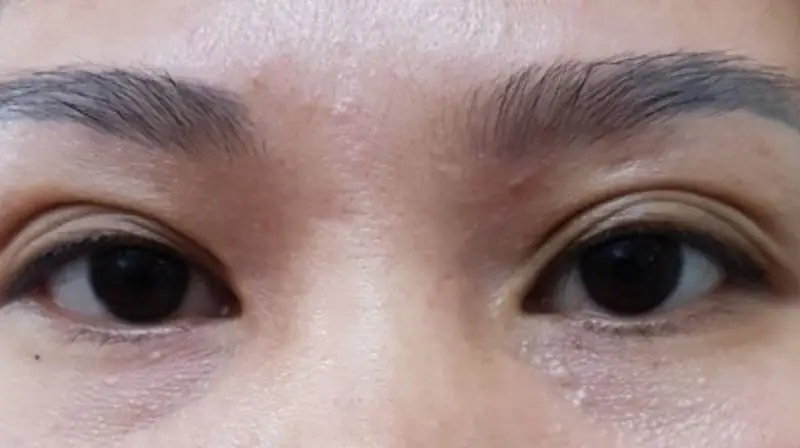 Mí mắt nhiều nếp gấp khiến đôi mắt già nua