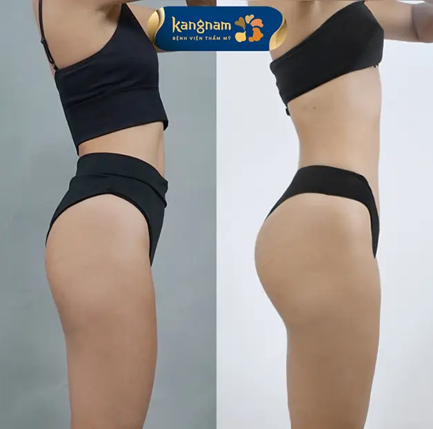 Phẫu thuật độn mông giúp cải thiện rõ rệt vùng mông lép, thiếu mô