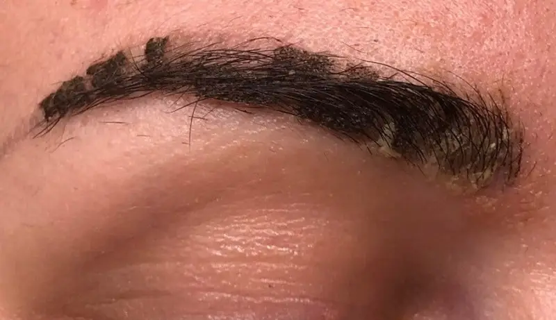 Quá trình lông mày bong vảy ăn thịt gà có thể gây ngứa ngáy vết thương