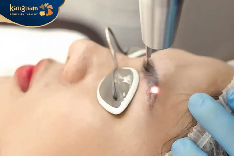 Xóa đường xăm cũng bằng phương pháp laser