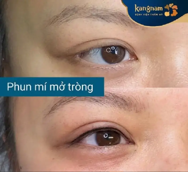 Phun mí mở tròng tạo đường mí sắc nét, an toàn cho mắt