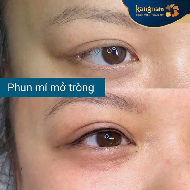 Kangnam ứng dụng phun mí mở tròng chất lượng cao