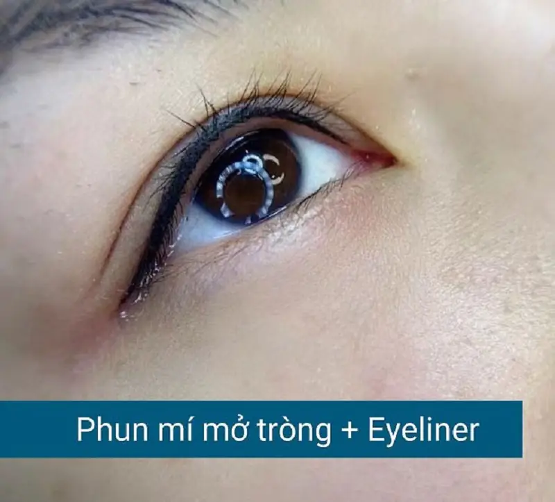 Khách hàng sở hữu được mí cân đối, hài hòa