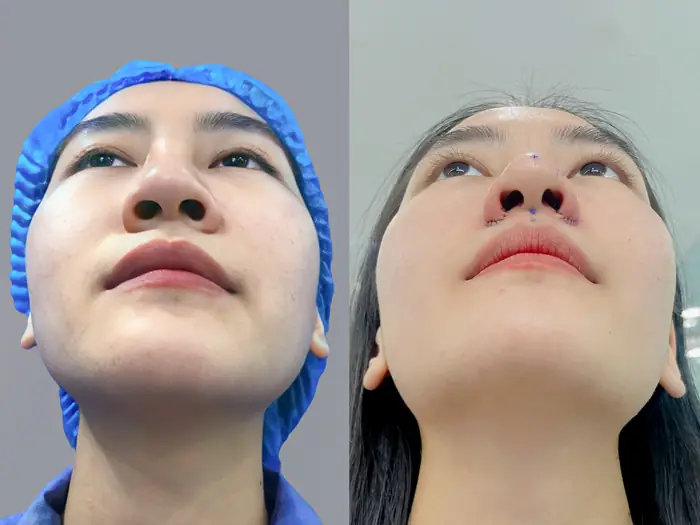 khách hàng thu gọn cánh mũi tại Kangnam, mũi hết to bè, gương mặt cân đối