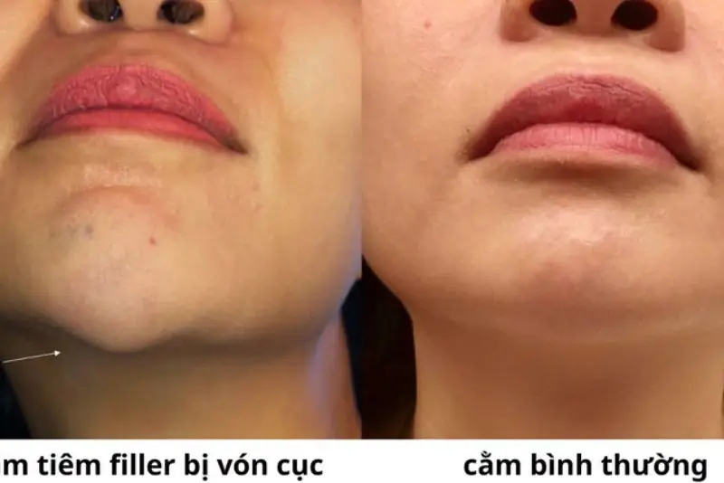 Phân biệt tình trạng vón cục sau tiêm filler