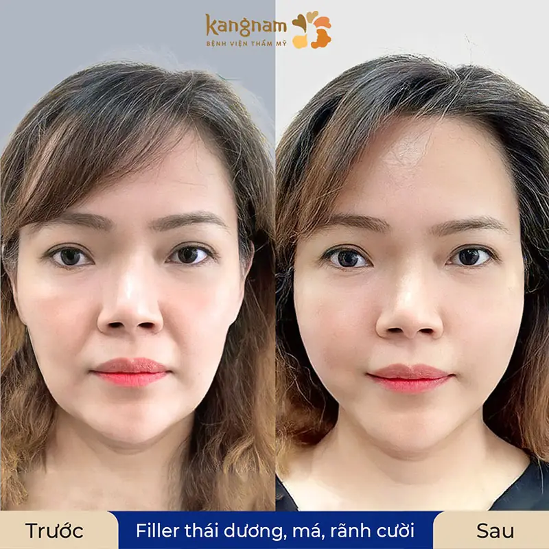 Khách hàng trước và sau khi tiêm filler tại Kangnam