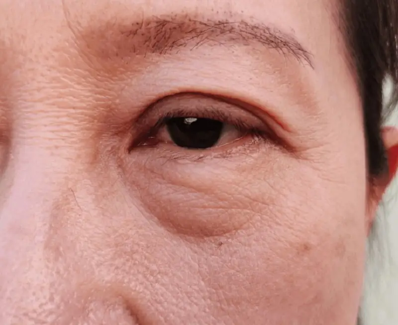 Bọng mắt khiến gương mặt già nua, kém sắc