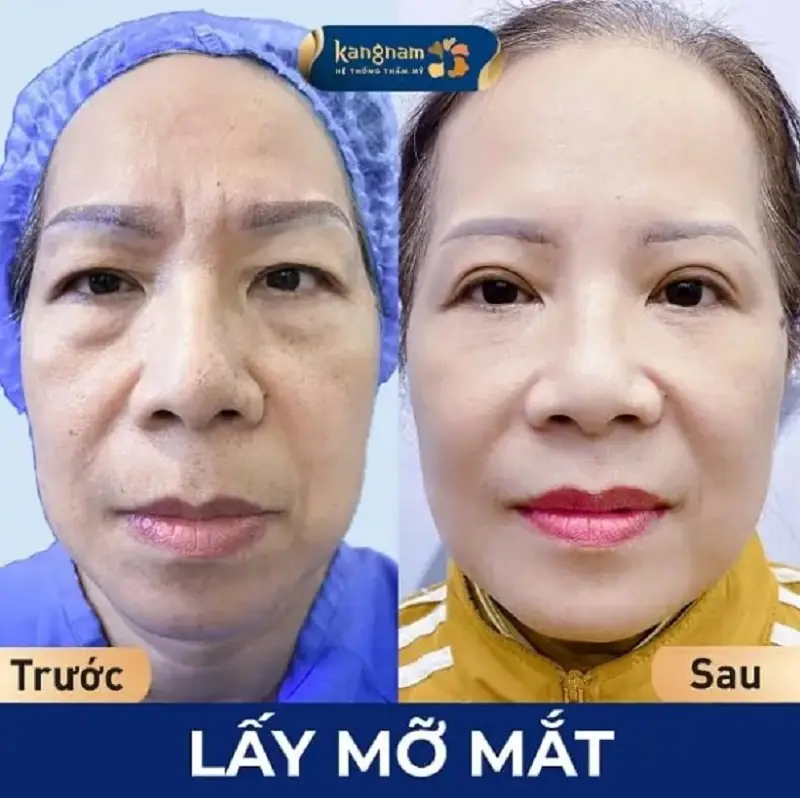Lấy bọng mỡ mắt giúp loại bỏ tình trạng mỡ dư thừa ở mí dưới