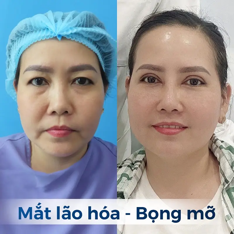 Cắt mí mắt giúp khắc phục mắt lão hóa, có bọng mắt