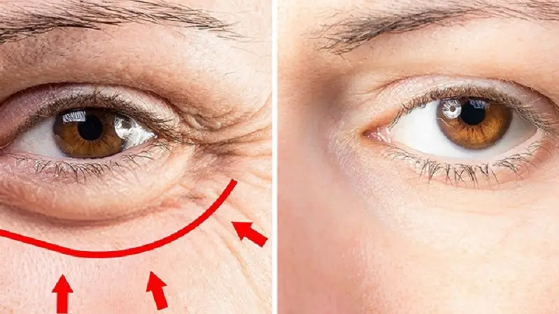 Bọng mắt to khiến gương mặt già nua, kém sắc