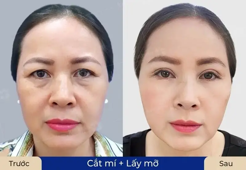 Cắt mí và lấy mỡ bọng mắt giúp gương mặt tươi trẻ hơn