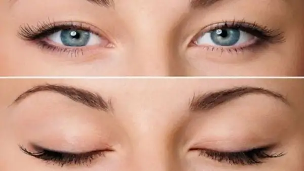 Bài tập chớp mắt có thể hỗ trợ cải tình trạng 1 mí