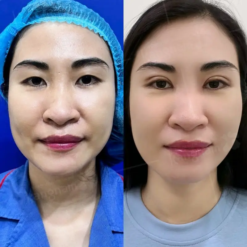 Cắt mí là phương pháp hiện đại, mang lại hiệu quả lâu dài