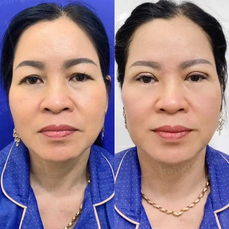 Cắt da thừa vùng mí mắt sẽ có giá thấp hơn