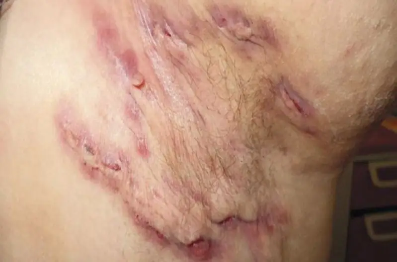 Nguy cơ nhiễm trùng, để lại sẹo khi cắt da thừa nách sai kỹ thuật