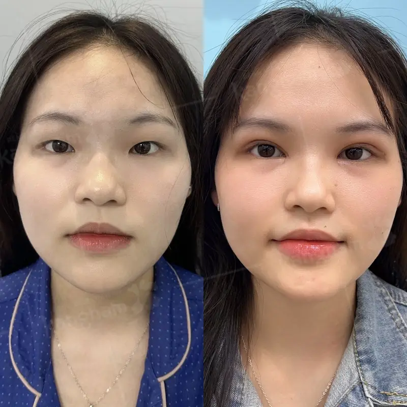 Cắt mắt mí lót giúp tạo nếp mí cân đối và hài hòa