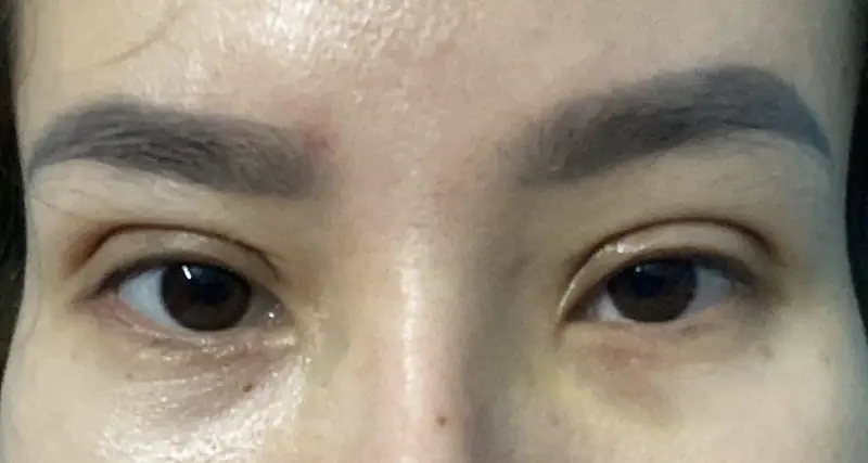 Cắt mí 1 bên to bên nhỏ gây mất cân đối