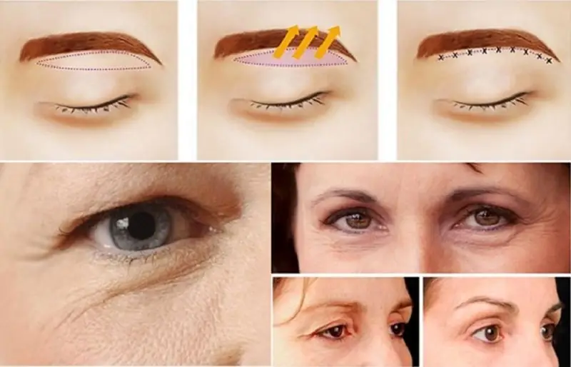 Kỹ thuật cắt treo cung chân mày khắc phục da chùng, nhão