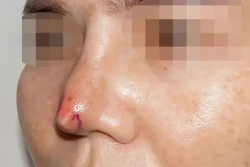 Cấu trúc mũi yếu có thể là nguyên nhân khiến mũi hỏng sau phẫu thuật