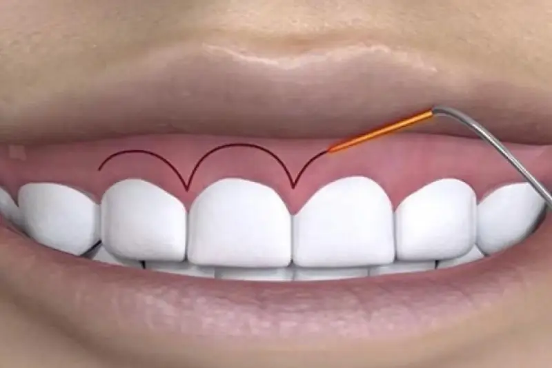 Phẫu thuật cắt nướu