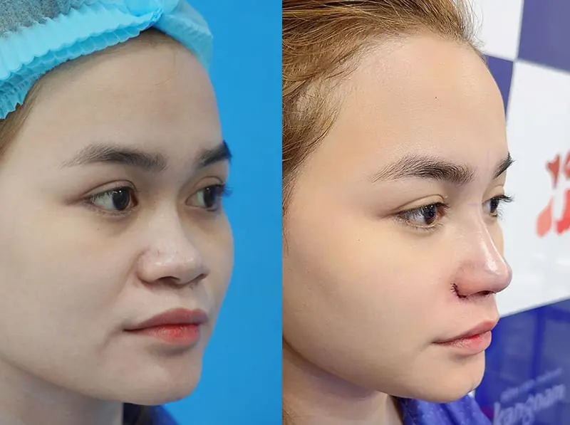 Nâng mũi cấu trúc khắc phục nhiều khuyết điểm