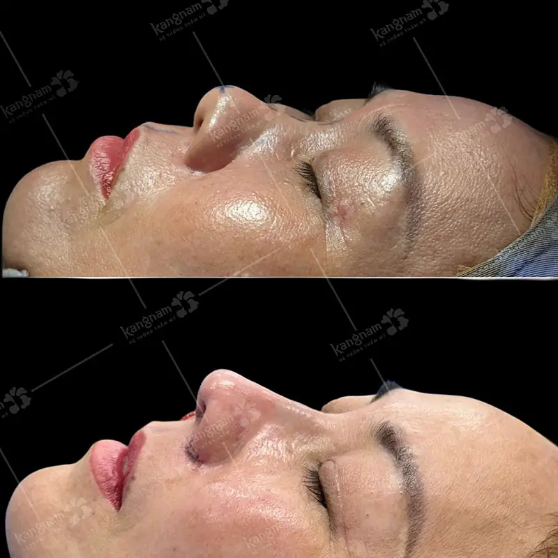 Thực tế, nâng mũi cấu trúc an toàn khi thực hiện đúng quy trình kỹ thuật