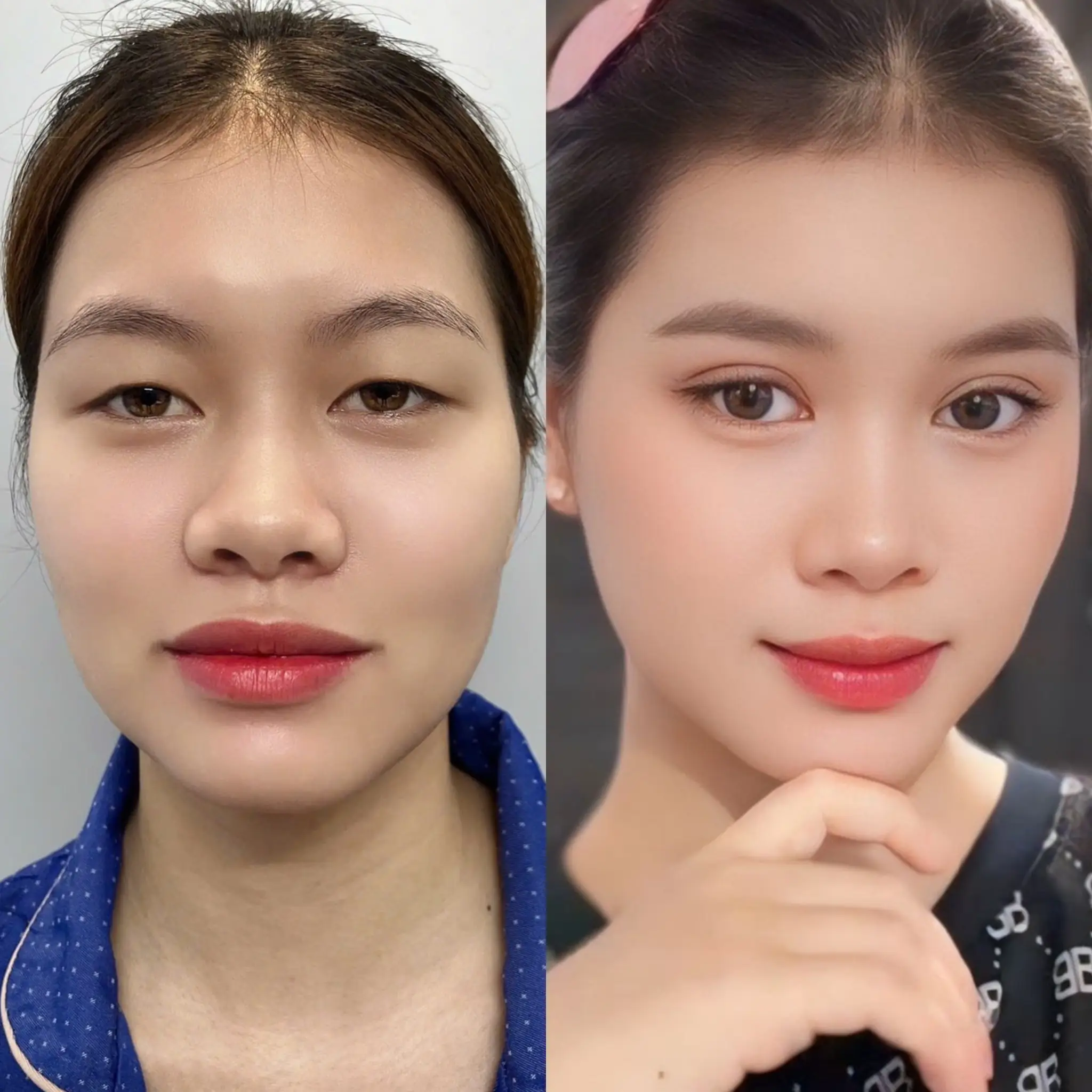Hình ảnh trước cắt mí Diệu Yến gặp tình trạng mí lót, sau khi thực hiện tại Kangnam chỉ 7 ngày nếp mí đã vào form, cân đối và tự nhiên