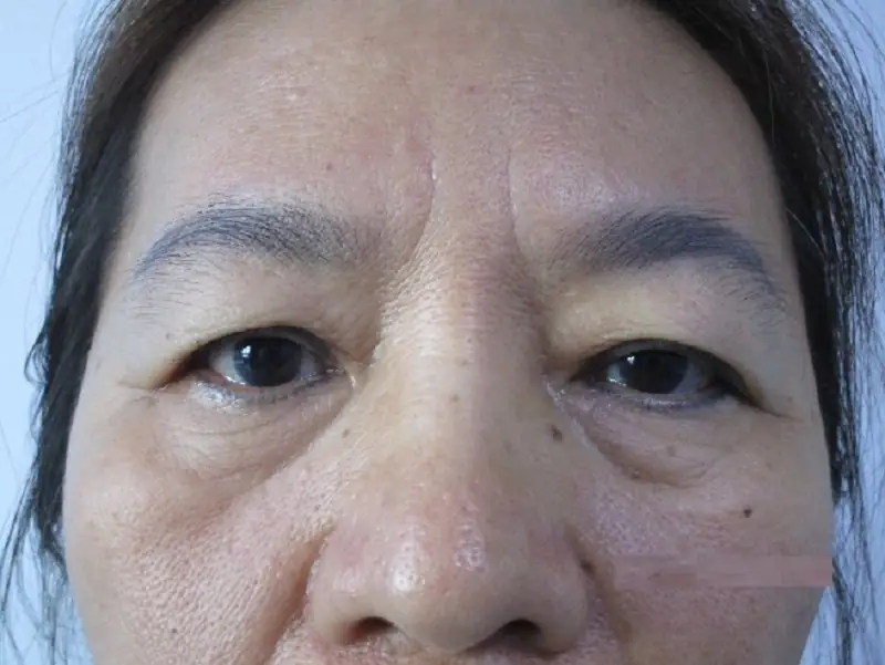 Tuổi tác tăng cao khiến mí mắt bị lão hóa và sụp mí