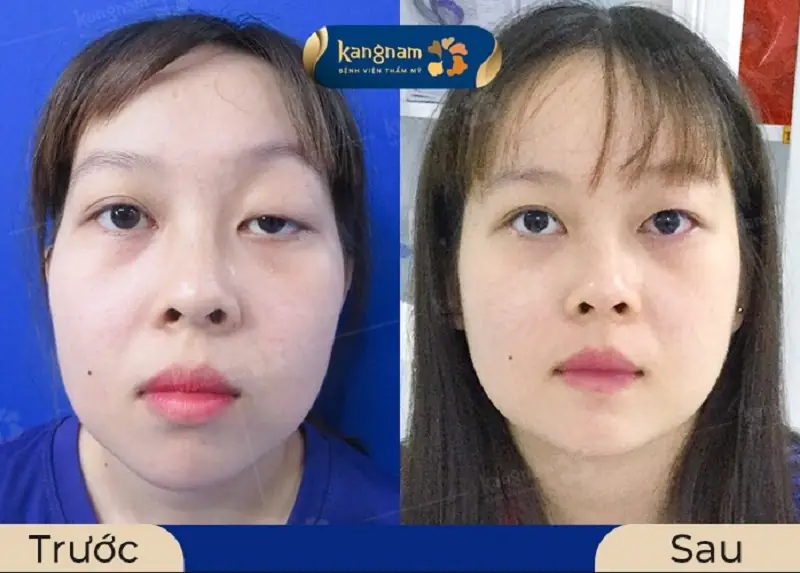 Khách hàng có thể thực hiện chỉnh hình mí sụp