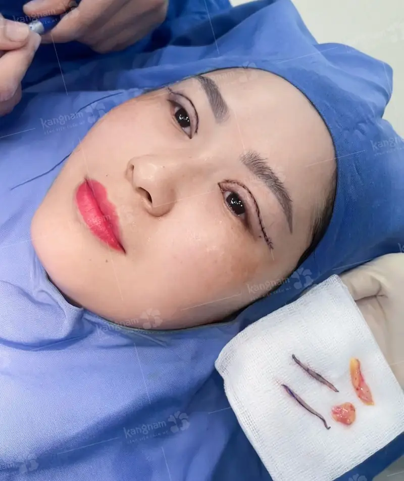 Bác sĩ loại bỏ da chùng, mỡ dư ở mí mắt