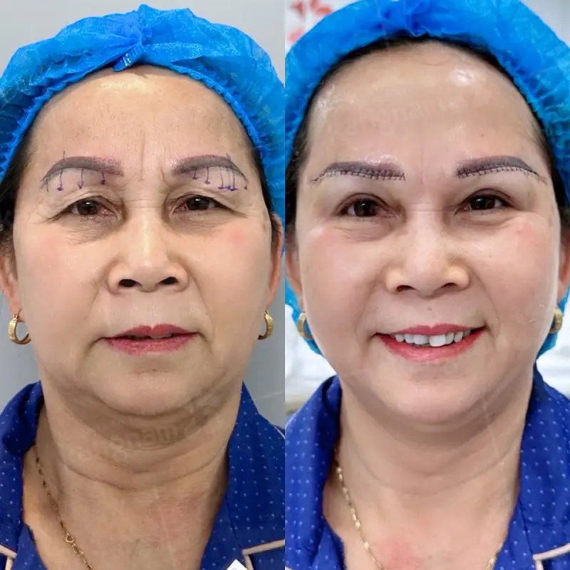 Khi mới nâng cung chân mày, vết thương vẫn còn sưng tấy