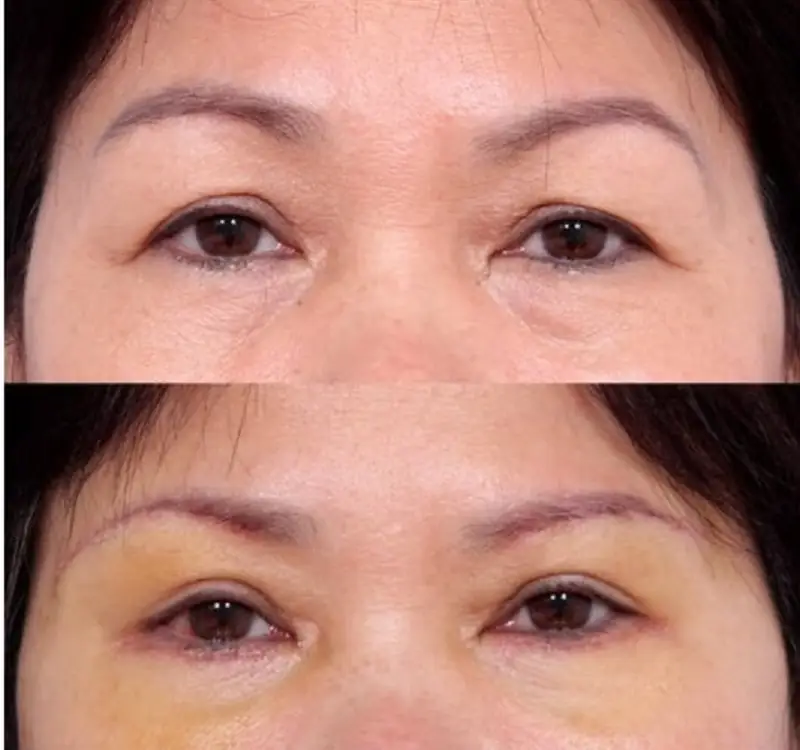 Sau nâng cung chân mày, vết thương sẽ liền và hết sẹo sau vài tháng
